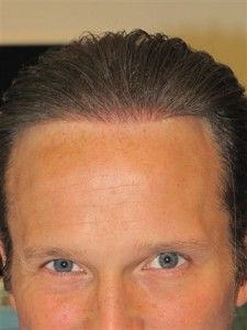 After Exoderm Artificial hair implant 