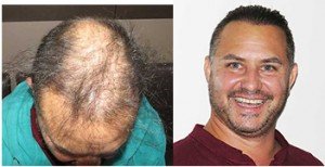 Exoderm-hair-implant4651-300x154