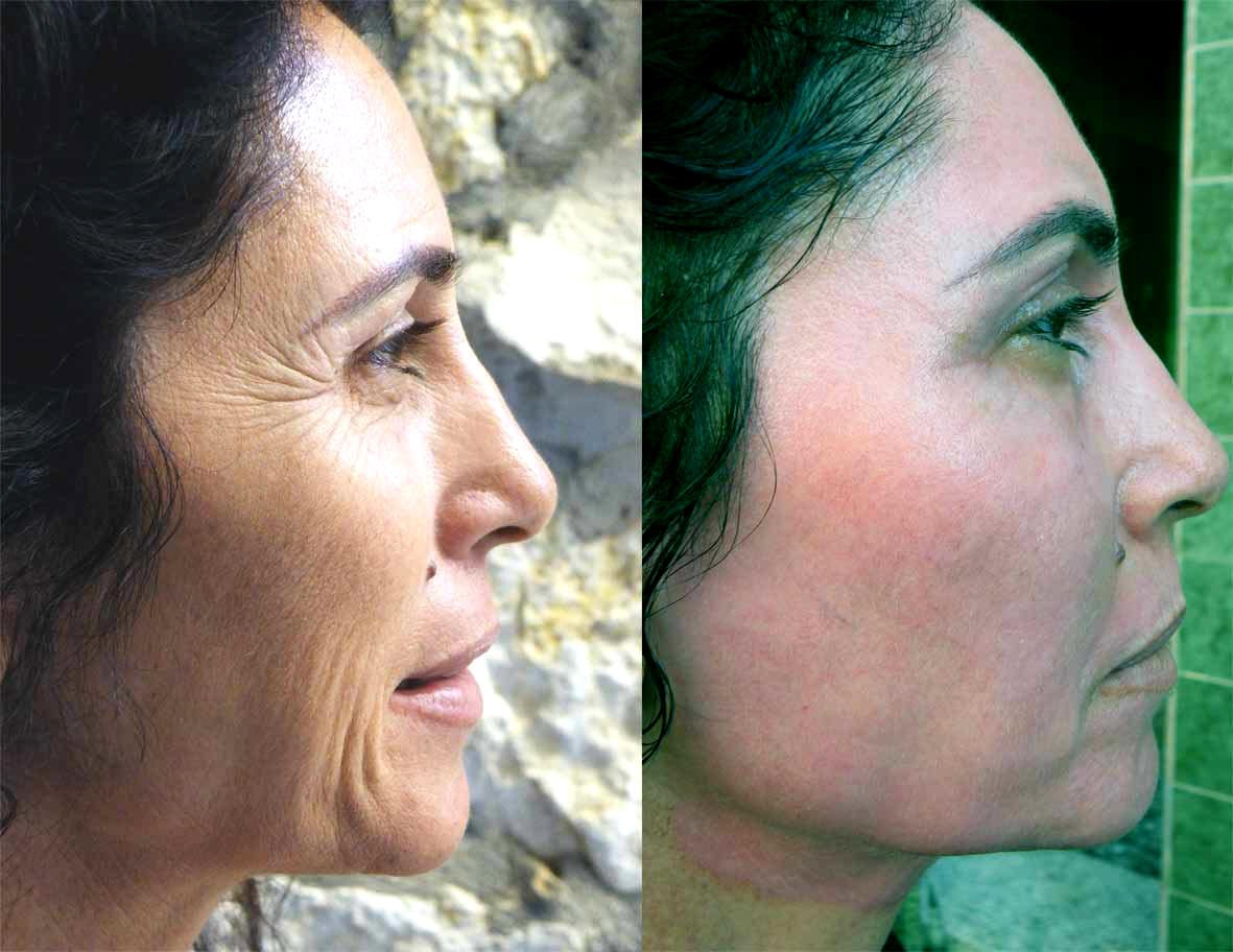 Exoderm Peel by Exoderm Medical Centers 